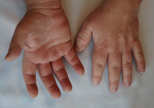 Cómo controlar el crecimiento excesivo en los niños